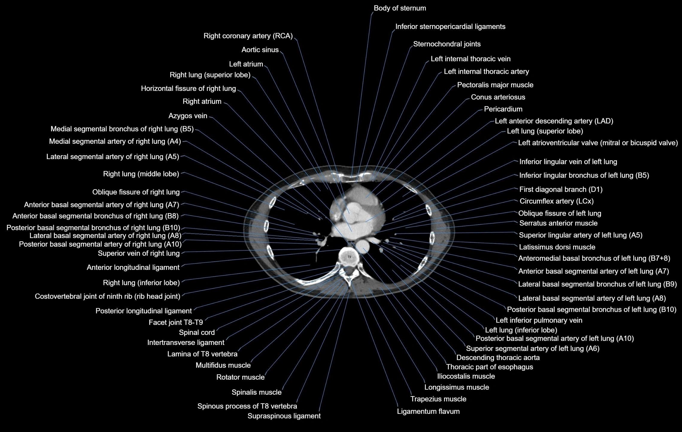 CT chest (thorax) soft tissue window labelled axial cross sectional anatomy radiology image-00072.webp